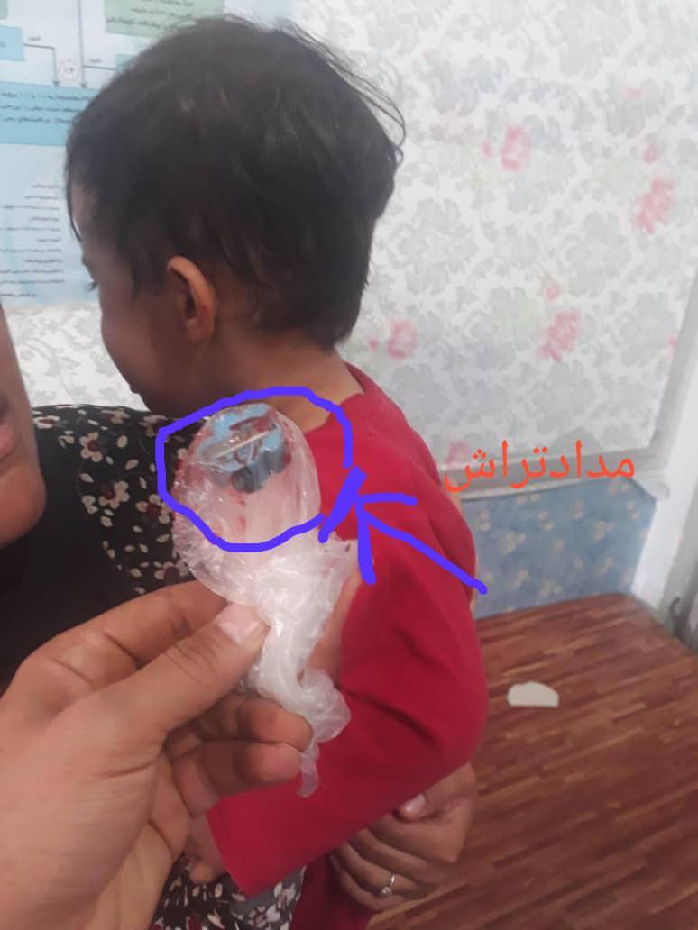 مدادتراش درگلوی کودک یکساله یاسوجی + عکس